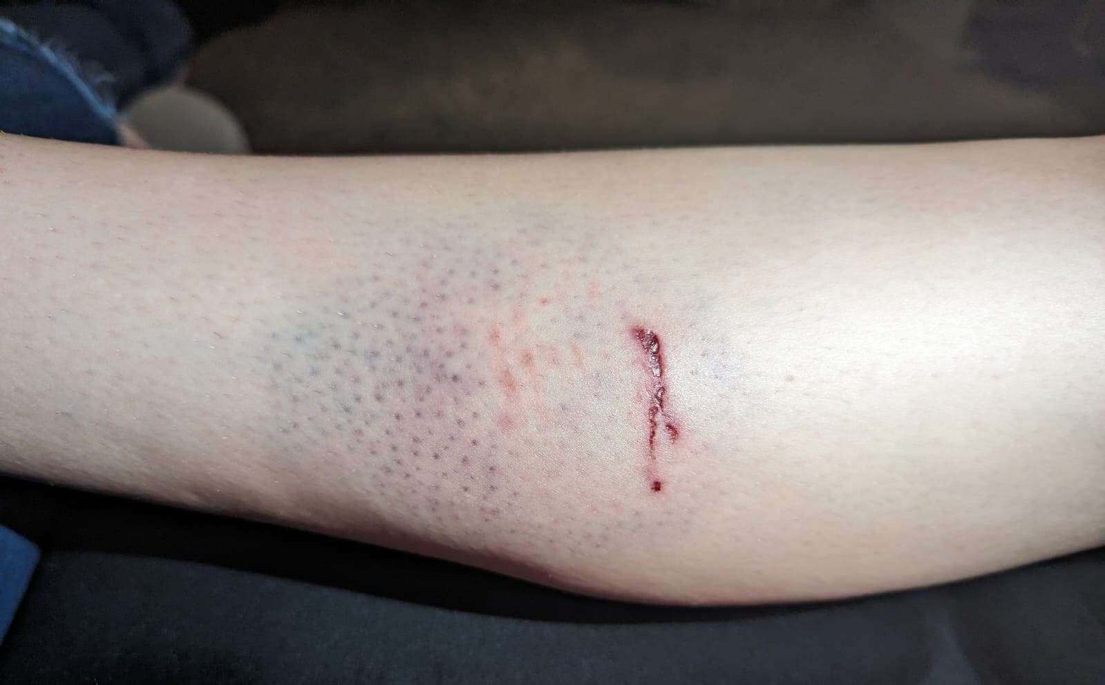 The bite has now caused bruising on the back of her leg. Picture: Chris Dixon