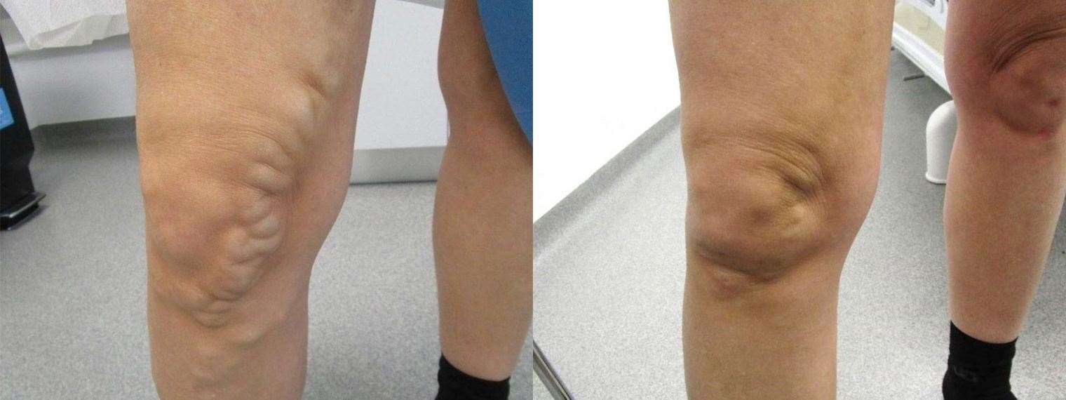 Before and after: Dr. Mo Farris treats all vein disorders including: varicose veins, venous insufficiency & ulcers, bulging hand veins and spider veins.