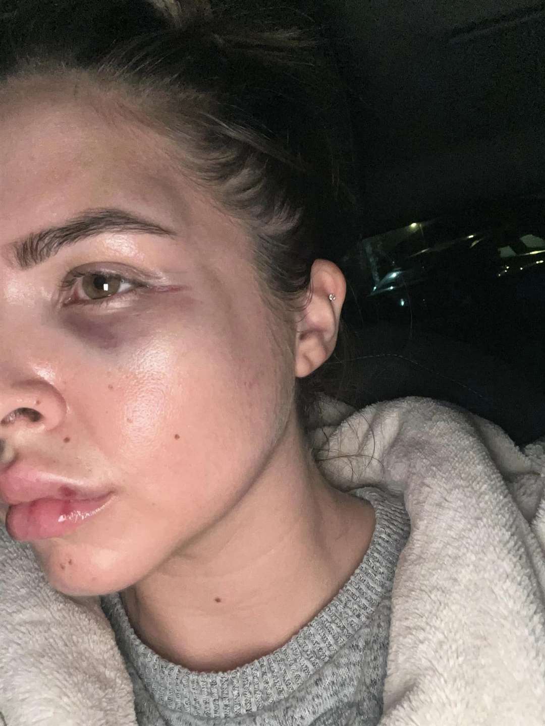 Nadia Zuccarello was left with a broken cheekbone. Picture: Nadia Zuccarello