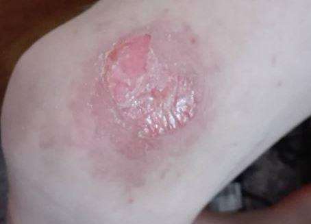 Dylan's 'giant hogweed' burn